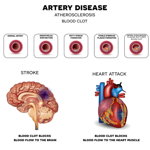Artery disease, Atherosclerosis, Stroke and Heart attack. Fatty plaque developing on the inside of the artery, at the end the artery is narrowed and blood clot blocks the artery.