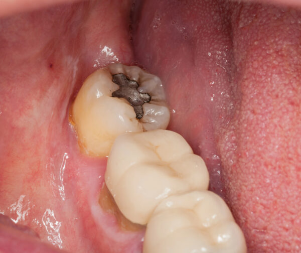 Silver mercury dental amalgam in a molar